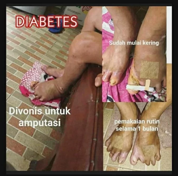 Testimoni Pasoien Diabetes